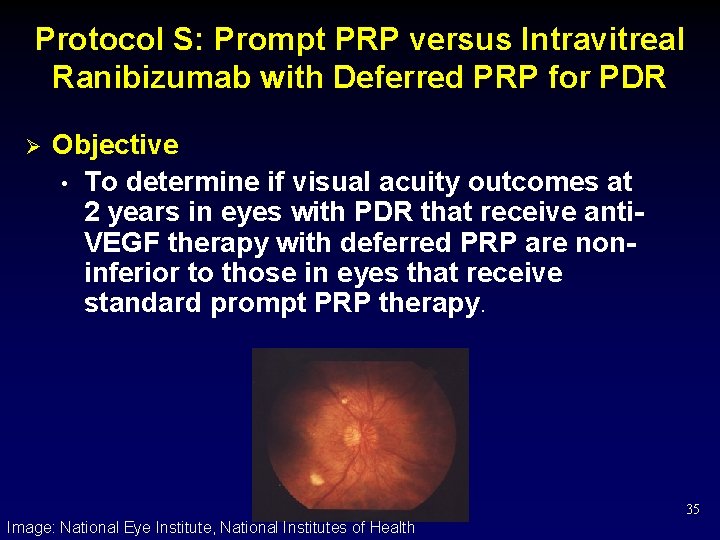 Protocol S: Prompt PRP versus Intravitreal Ranibizumab with Deferred PRP for PDR Ø Objective