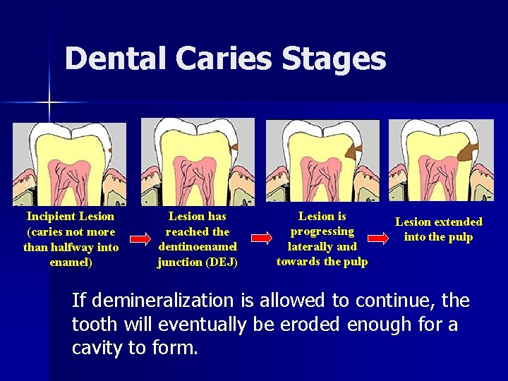Dental Caries Stages Incipient Lesion (caries not more than halfway into enamel) Lesion has