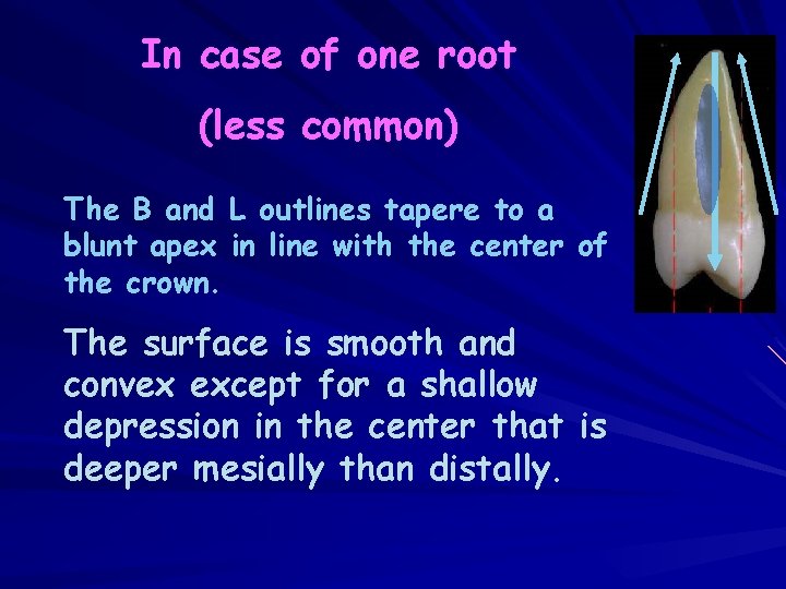 In case of one root (less common) The B and L outlines tapere to