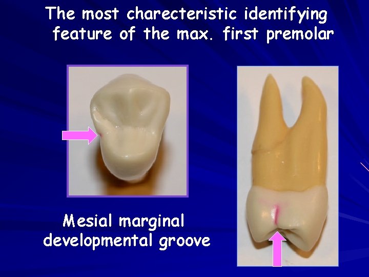 The most charecteristic identifying feature of the max. first premolar Mesial marginal developmental groove