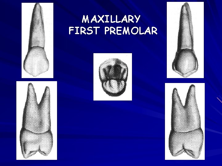MAXILLARY FIRST PREMOLAR 