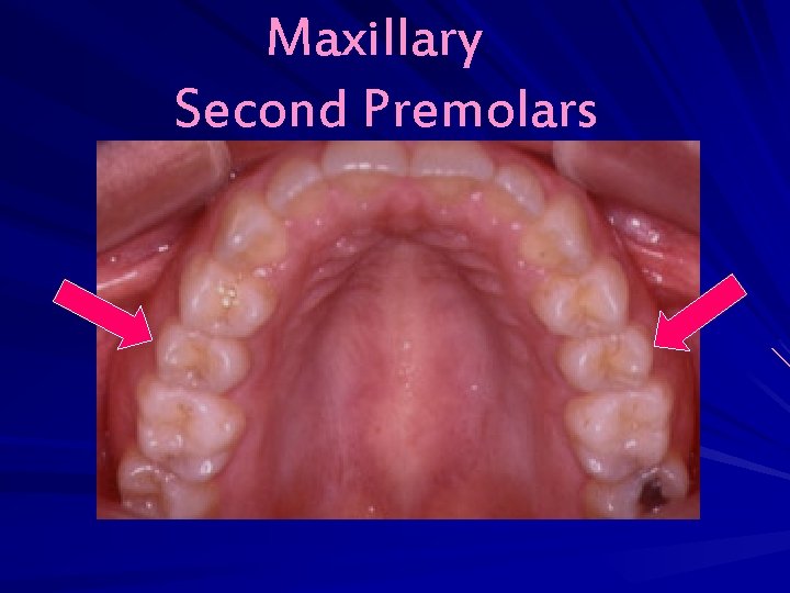 Maxillary Second Premolars 