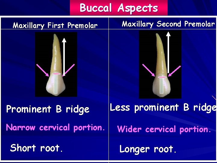 Buccal Aspects Maxillary First Premolar Prominent B ridge Narrow cervical portion. Short root. Maxillary