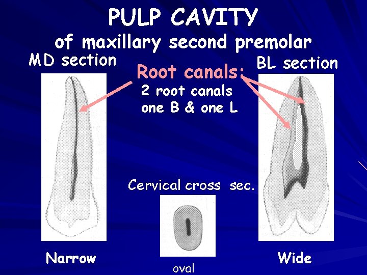 PULP CAVITY of maxillary second premolar MD section Root canals: BL section 2 root