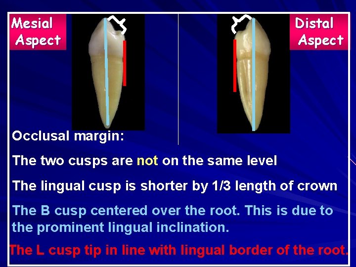 Mesial Aspect Distal Aspect Occlusal margin: The two cusps are not on the same