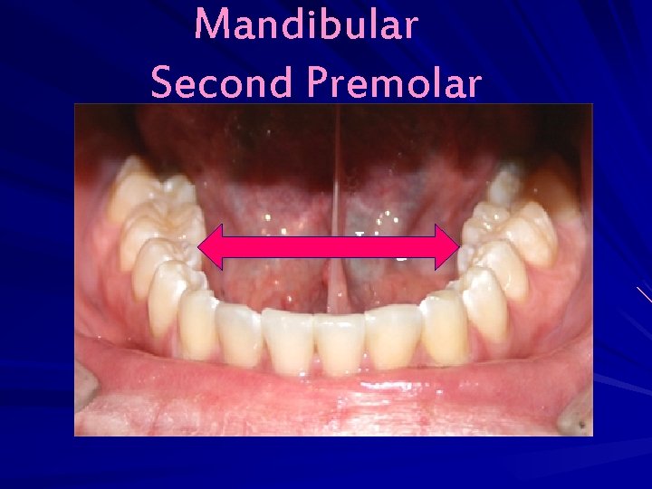 Mandibular Second Premolar 