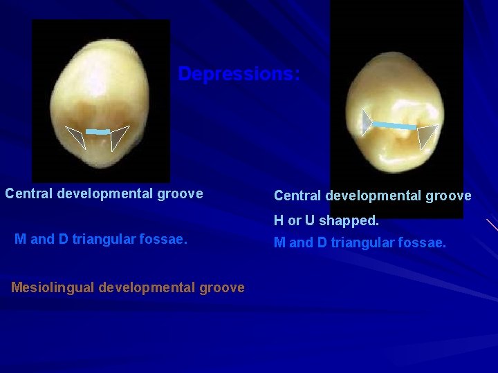 Depressions: Central developmental groove H or U shapped. M and D triangular fossae. Mesiolingual
