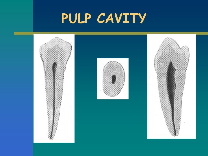 PULP CAVITY 