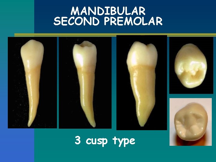 MANDIBULAR SECOND PREMOLAR 3 cusp type 