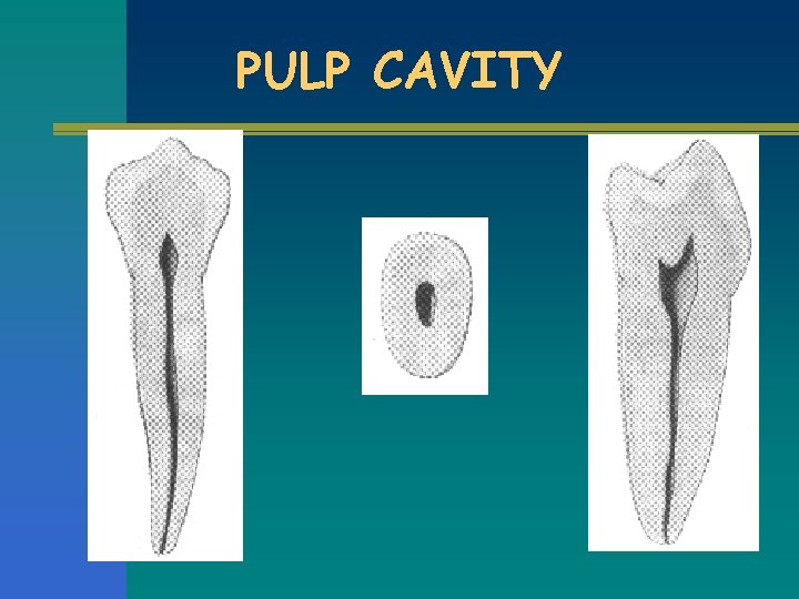 PULP CAVITY 