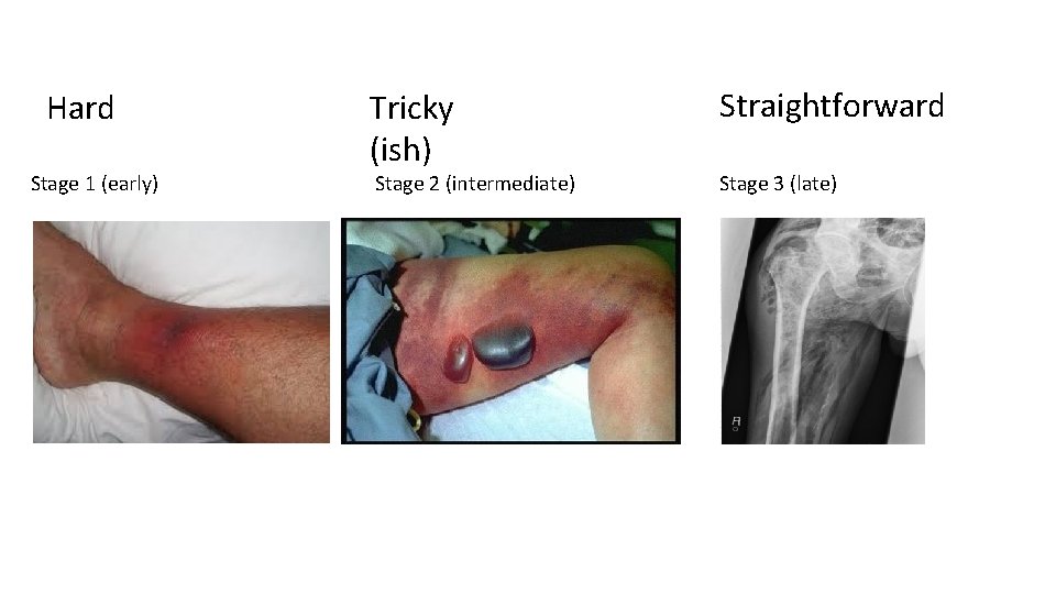 Hard Stage 1 (early) Tricky (ish) Straightforward Stage 2 (intermediate) Stage 3 (late) Blister
