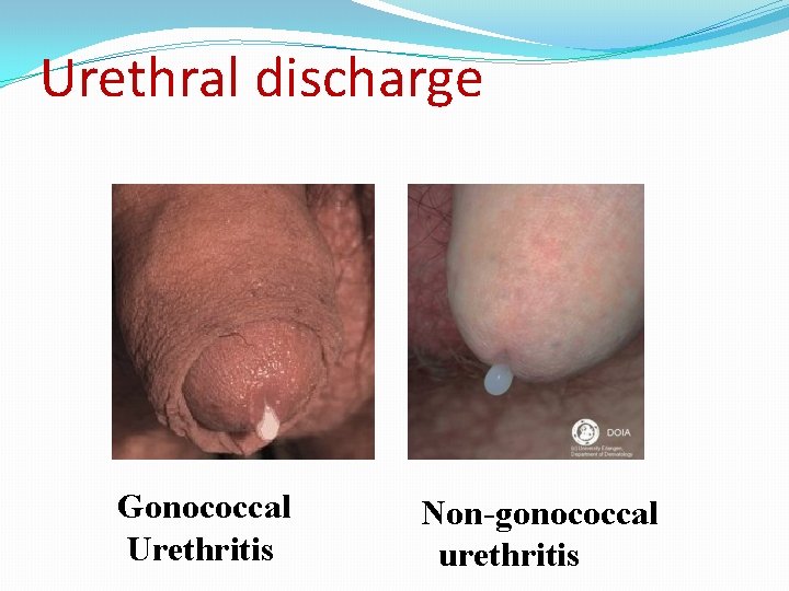 Urethral discharge Gonococcal Urethritis Non-gonococcal urethritis 