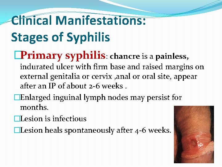 Clinical Manifestations: Stages of Syphilis �Primary syphilis: chancre is a painless, indurated ulcer with