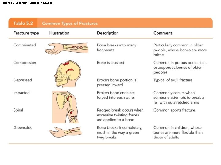 Table 5. 2 Common Types of Fractures. 