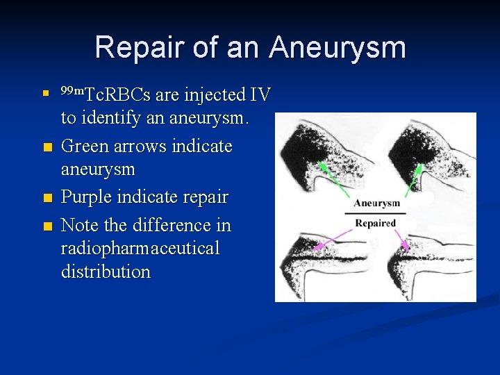Repair of an Aneurysm n n 99 m. Tc. RBCs are injected IV to