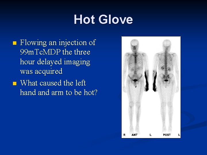 Hot Glove n n Flowing an injection of 99 m. Tc. MDP the three