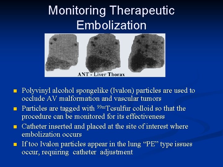 Monitoring Therapeutic Embolization n n Polyvinyl alcohol spongelike (Ivalon) particles are used to occlude