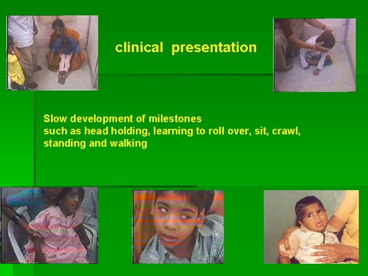 clinical presentation Slow development of milestones such as head holding, learning to roll over,