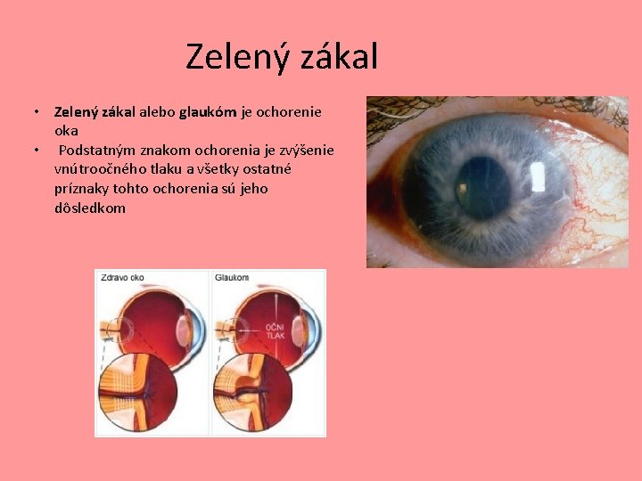 Zelený zákal • Zelený zákal alebo glaukóm je ochorenie oka • Podstatným znakom ochorenia