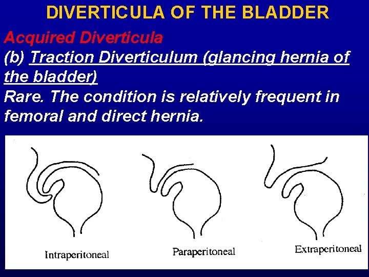 DIVERTICULA OF THE BLADDER Acquired Diverticula (b) Traction Diverticulum (glancing hernia of the bladder)