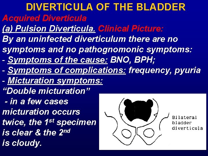 DIVERTICULA OF THE BLADDER Acquired Diverticula (a) Pulsion Diverticula. Clinical Picture: By an uninfected