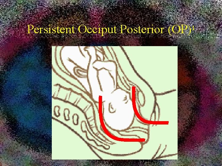 Persistent Occiput Posterior (OP)1 