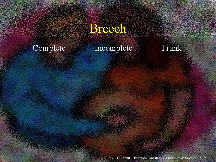 Breech Complete Incomplete Frank From: Chestnut. Obstetrical Anesthesia, Principles & Practice 3 rd Ed