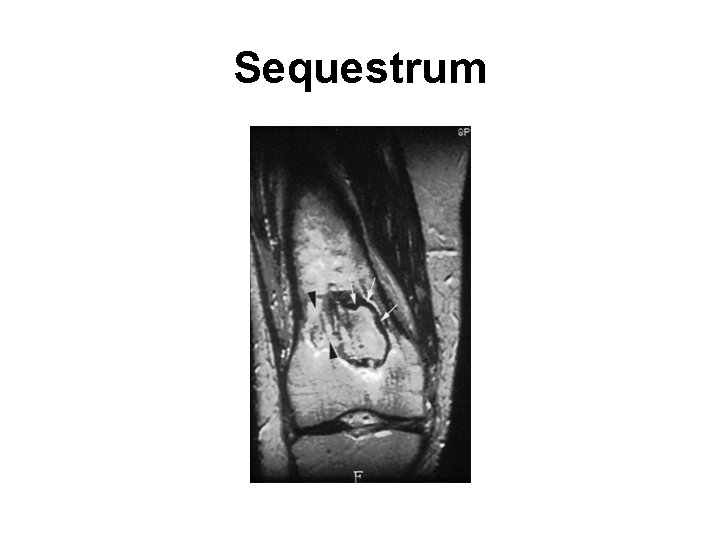 Sequestrum 
