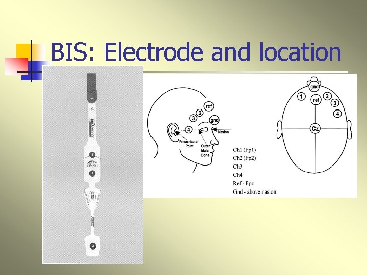 BIS: Electrode and location 
