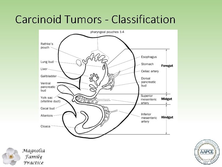 Carcinoid Tumors - Classification 