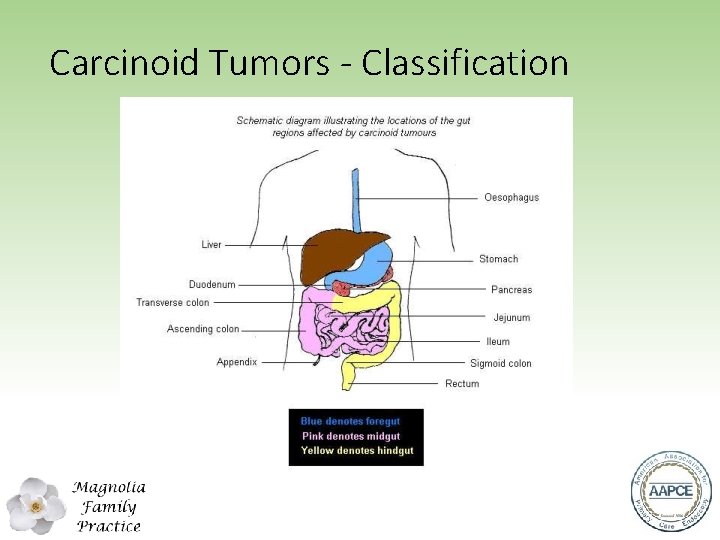 Carcinoid Tumors - Classification 