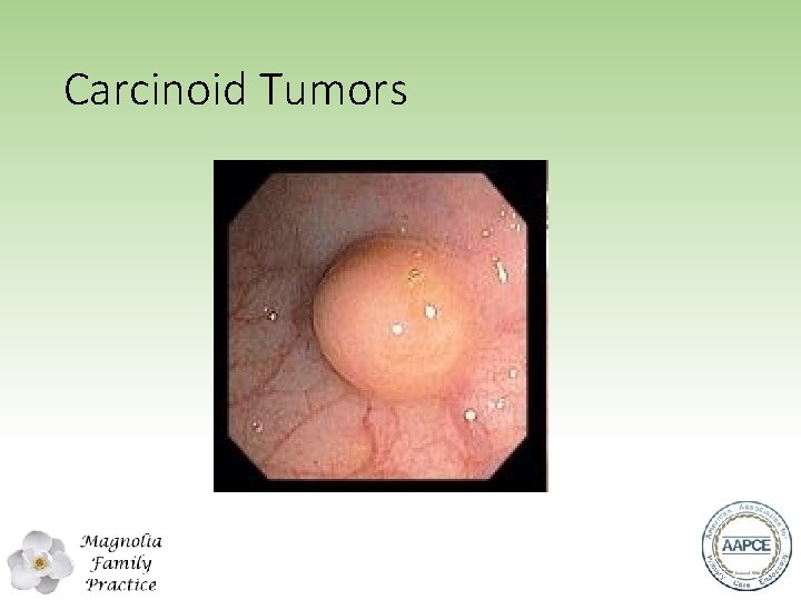 Carcinoid Tumors 