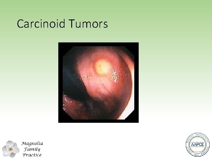 Carcinoid Tumors 
