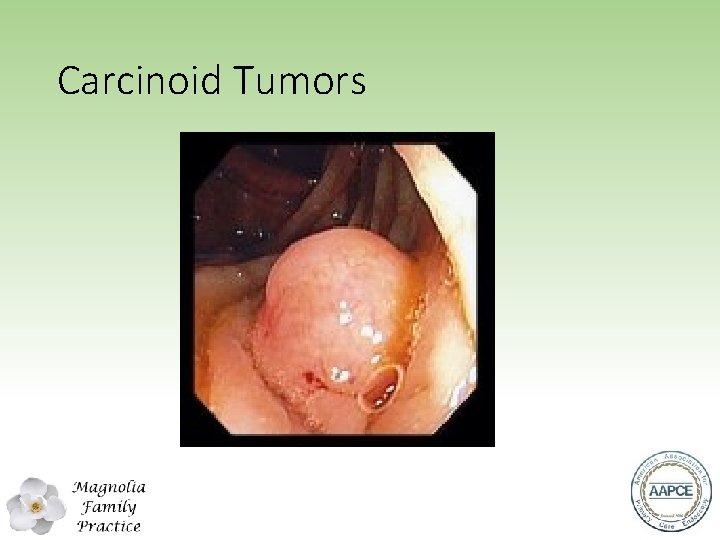 Carcinoid Tumors 