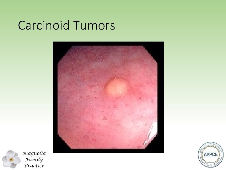 Carcinoid Tumors 