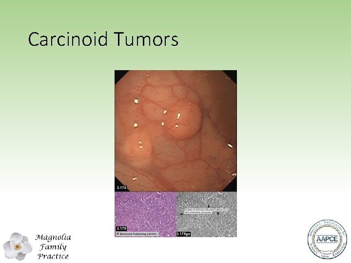 Carcinoid Tumors 