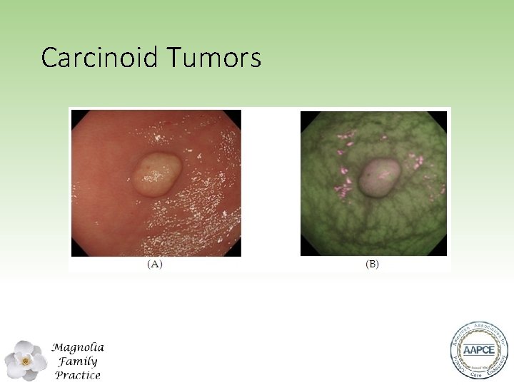 Carcinoid Tumors 