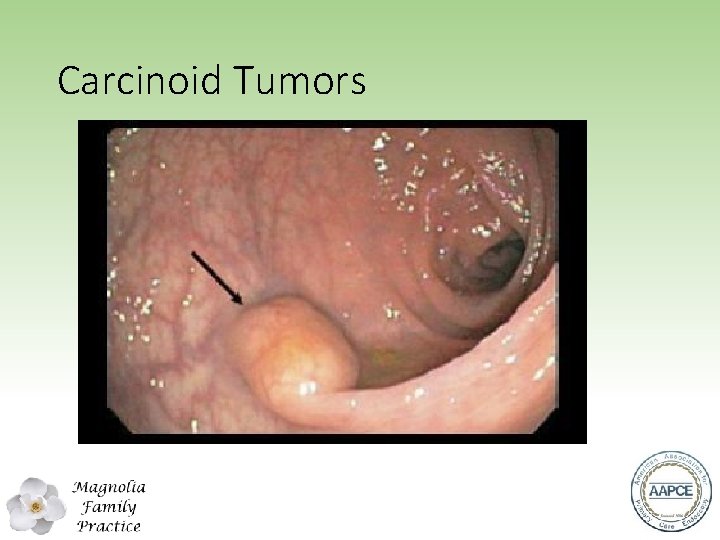 Carcinoid Tumors 