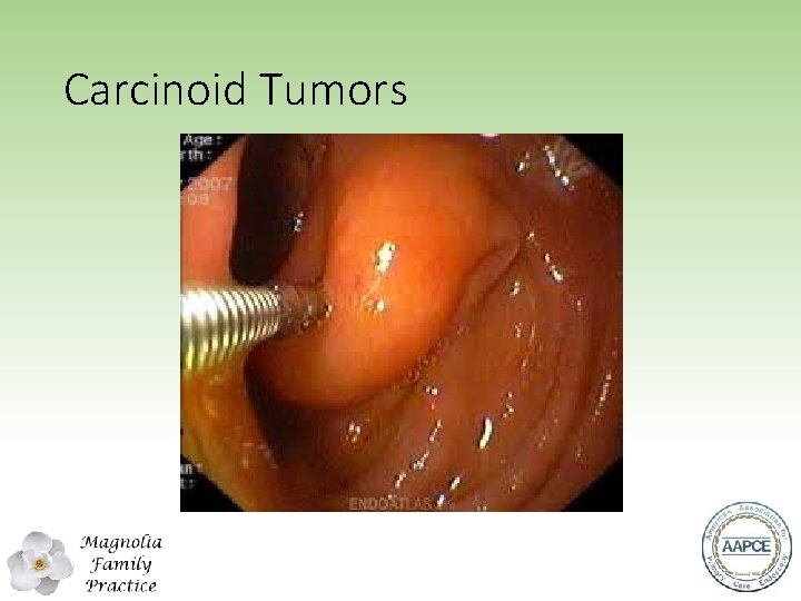 Carcinoid Tumors 