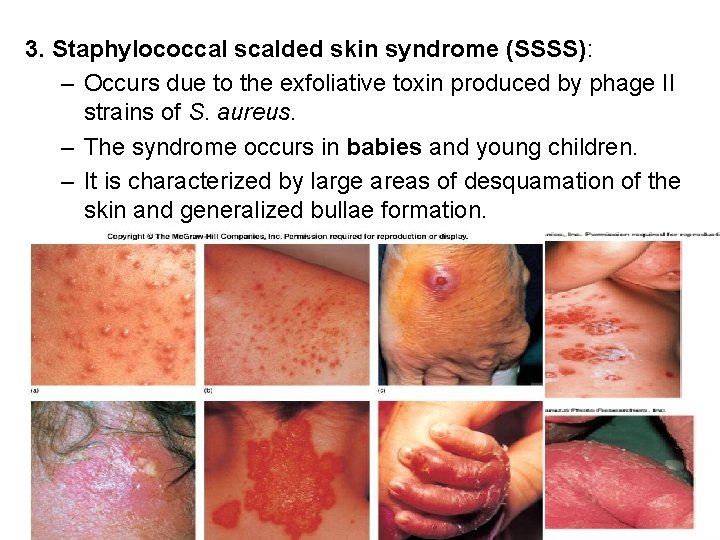 3. Staphylococcal scalded skin syndrome (SSSS): – Occurs due to the exfoliative toxin produced