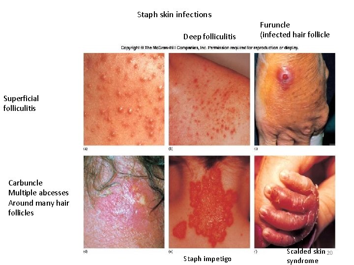 Staph skin infections Deep folliculitis Furuncle (infected hair follicle Superficial folliculitis Carbuncle Multiple abcesses