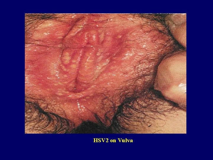 HSV 2 on Vulva 