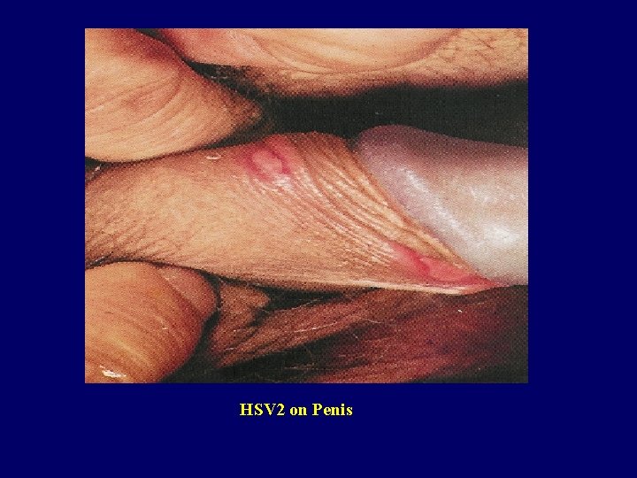 HSV 2 on Penis 