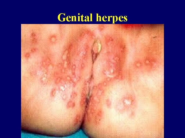 Genital herpes 
