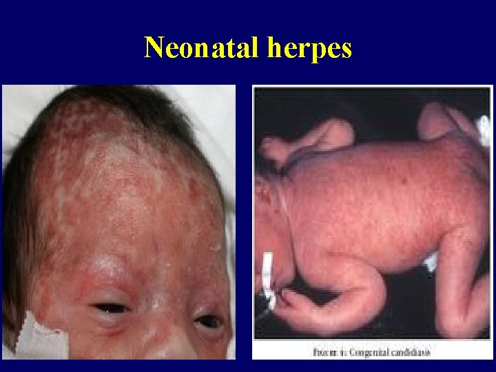 Neonatal herpes 