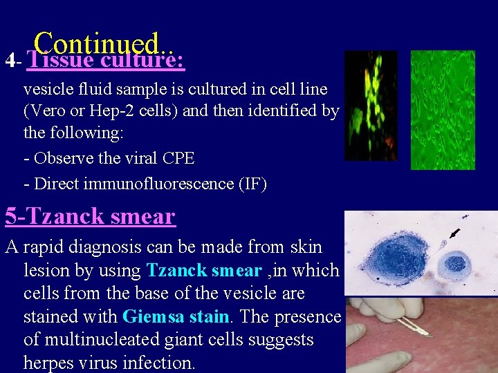 Continued. . 4 - Tissue culture: vesicle fluid sample is cultured in cell line