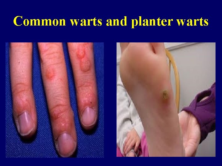 Common warts and planter warts 