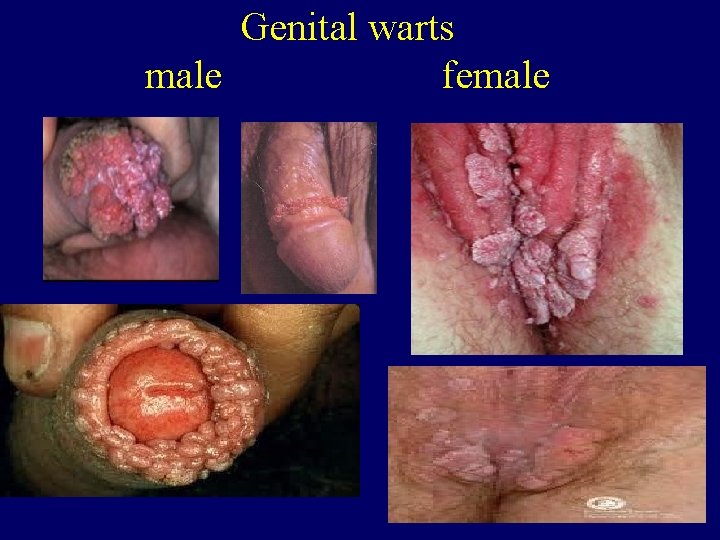 Genital warts male female 