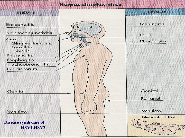 Disease syndrome of HSV 1, HSV 2 