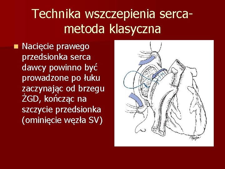 Technika wszczepienia sercametoda klasyczna n Nacięcie prawego przedsionka serca dawcy powinno być prowadzone po